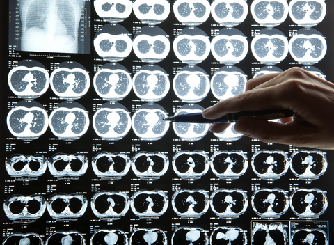 Frying Your Brain With Fructose and Glucose:  “Sugar-Brain”