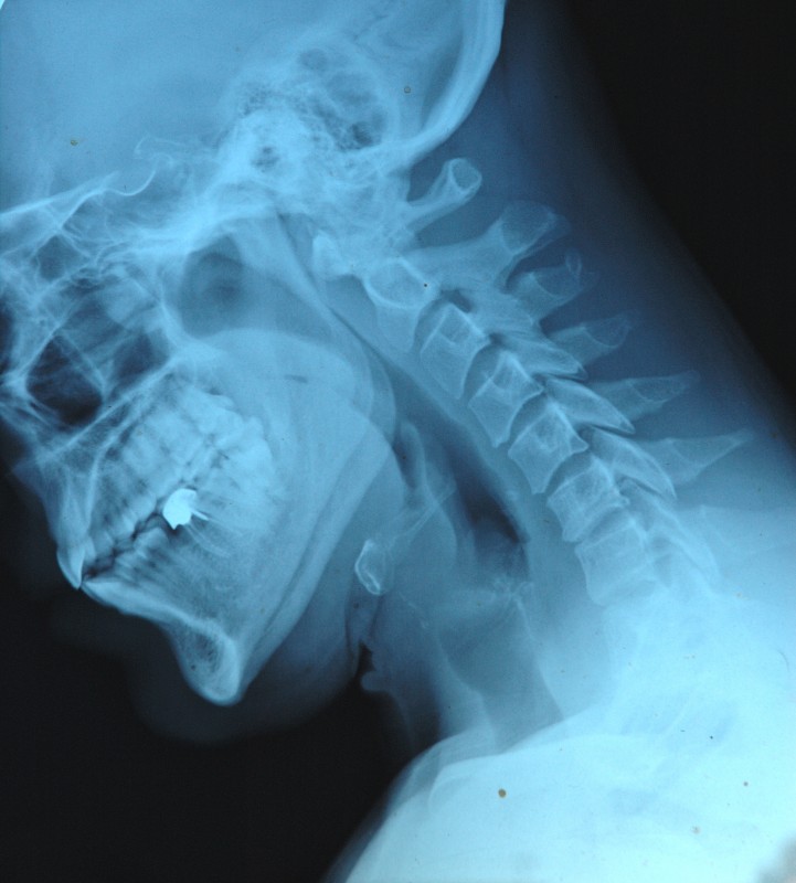 Mercola reports Excess Iron May Actually Increase Senility in Many. July 19, 2012